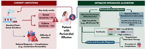 This prospective study evaluated the GeneXpert MTB/RIF® test (Cepheid Inc., USA) for diagnosing pericardial tuberculosis (TBP) in comparison with culture, the reference method recommended by the Moroccan National Tuberculosis Control Program (PNLAT). Twenty-seven pericardial fluid samples collected over 36 months at Ibn Sina University Hospital, Rabat, were analysed using bacilloscopy, culture, and GeneXpert MTB/RIF. Microscopy showed no positive results, whereas GeneXpert MTB/RIF and culture yielded positivity rates of 14.81% and 11.11%, respectively; the assay also demonstrated 100% sensitivity and NPV, with 95.8% specificity and 75% PPV. These findings indicate that GeneXpert MTB/RIF is a rapid and reliable first-line diagnostic tool for pericardial tuberculosis, providing results much faster than culture.