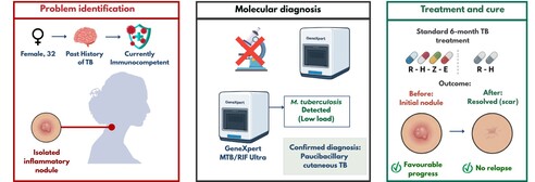 Cutaneous tuberculosis is an uncommon paucibacillary form of extrapulmonary tuberculosis with diverse clinical presentations, complicating diagnosis. We report the case of a 32-year-old immunocompetent woman vaccinated with BCG and previously treated for neuromeningeal tuberculosis, who developed a progressive cervicothoracic skin lesion. Conventional microbiological tests were negative, whereas GeneXpert MTB/RIF Ultra on a skin biopsy detected Mycobacterium tuberculosis DNA without rifampicin resistance, confirming secondary scrofuloderma. Standard antituberculosis therapy led to a favourable outcome without recurrence.